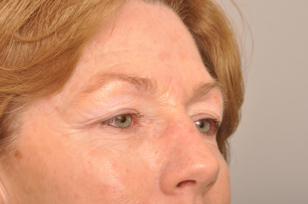 Brow Lift Delaware | Premier Cosmetic Surgery DE