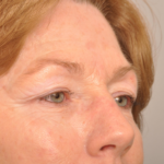 Brow Lift Delaware | Premier Cosmetic Surgery DE