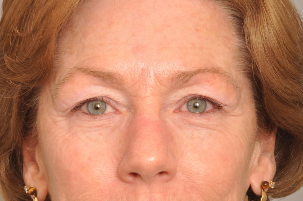 Brow Lift Delaware | Premier Cosmetic Surgery DE