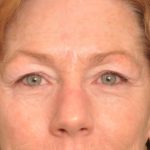 Brow Lift Delaware | Premier Cosmetic Surgery DE