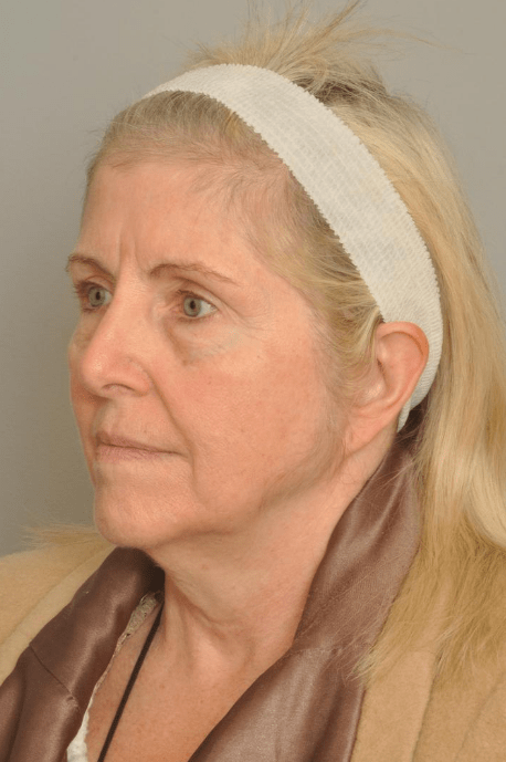 Brow Lift Delaware | Premier Cosmetic Surgery DE