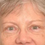 Brow Lift Delaware | Premier Cosmetic Surgery DE