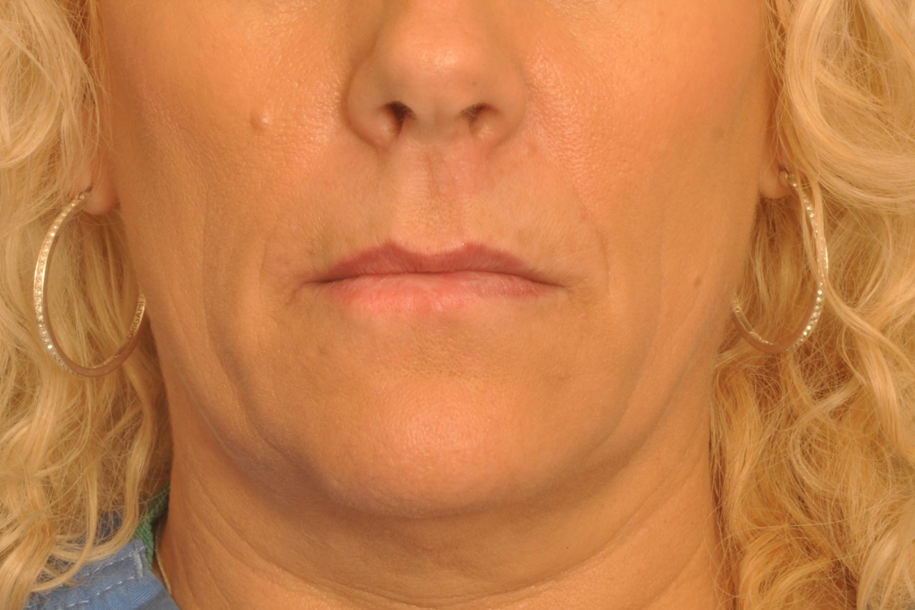 MOHS Reconstruction Delaware | Premier Cosmetic Surgery DE