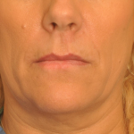 MOHS Reconstruction Delaware | Premier Cosmetic Surgery DE