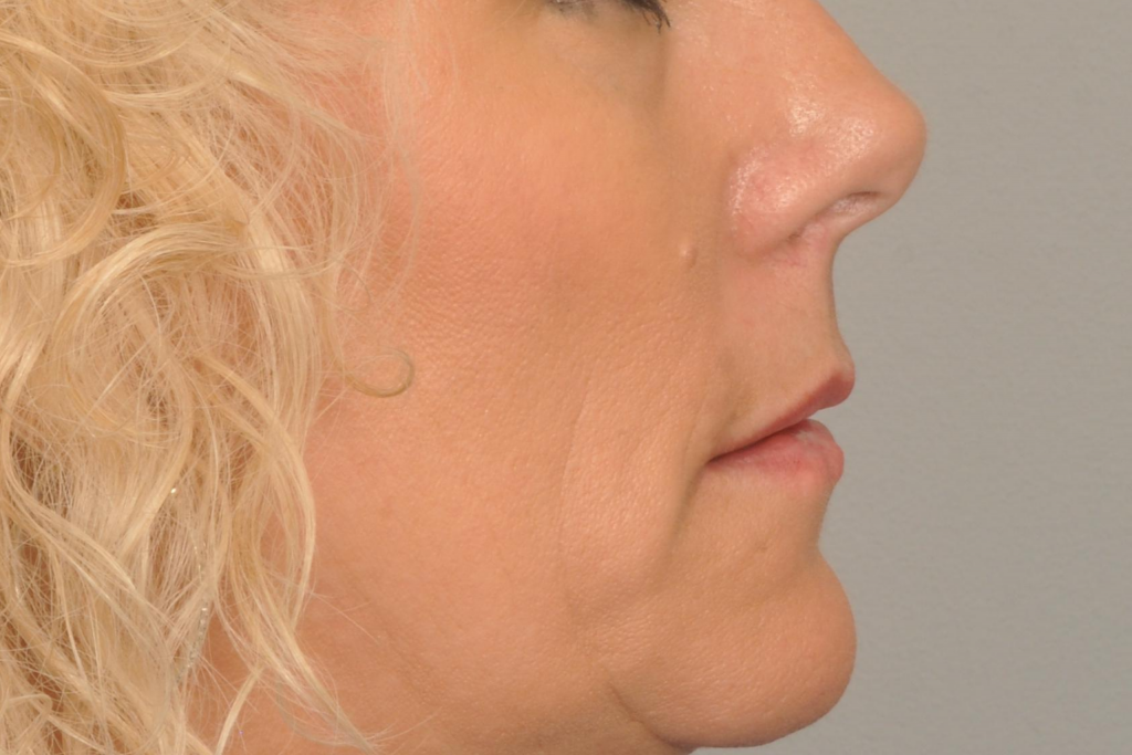 MOHS Reconstruction Delaware | Premier Cosmetic Surgery DE