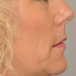 MOHS Reconstruction Delaware | Premier Cosmetic Surgery DE