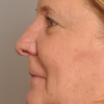 MOHS Reconstruction Delaware | Premier Cosmetic Surgery DE