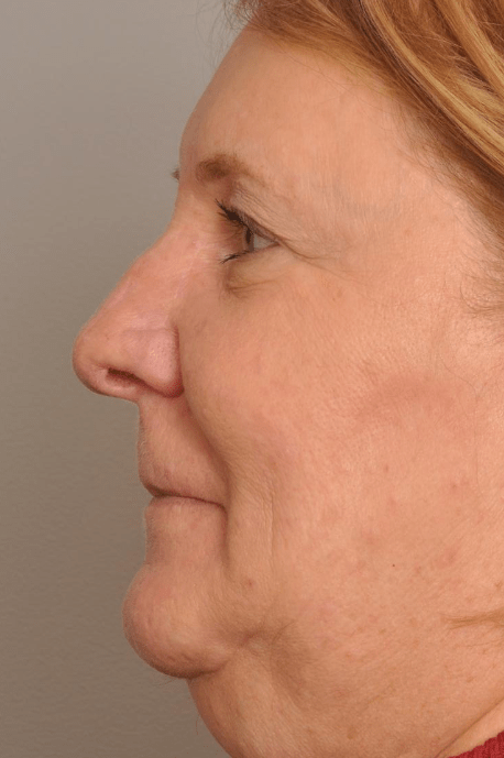 MOHS Reconstruction Delaware | Premier Cosmetic Surgery DE