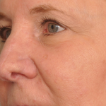 MOHS Reconstruction Delaware | Premier Cosmetic Surgery DE