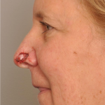 MOHS Reconstruction Delaware | Premier Cosmetic Surgery DE