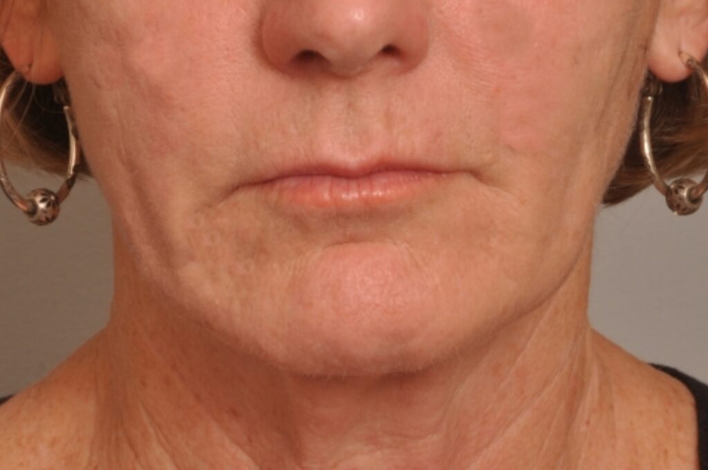 Chemical Peel Delaware | Premier Cosmetic Surgery DE