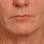 Chemical Peel Delaware | Premier Cosmetic Surgery DE