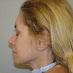 Chemical Peel Delaware | Premier Cosmetic Surgery DE