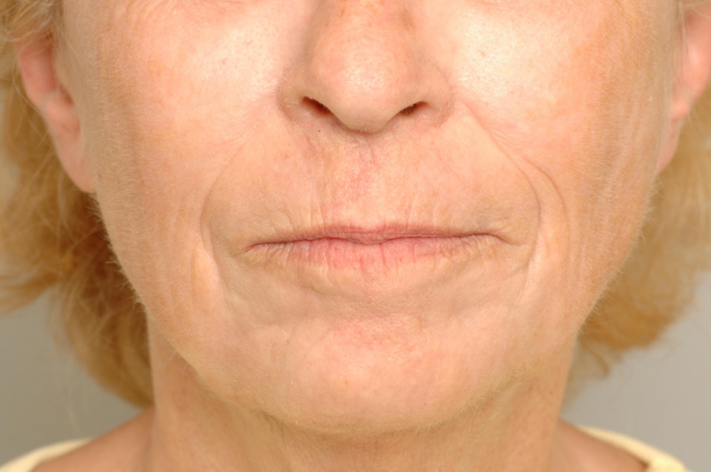 Chemical Peel Delaware | Premier Cosmetic Surgery DE