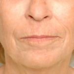 Chemical Peel Delaware | Premier Cosmetic Surgery DE