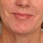 Chemical Peel Delaware | Premier Cosmetic Surgery DE