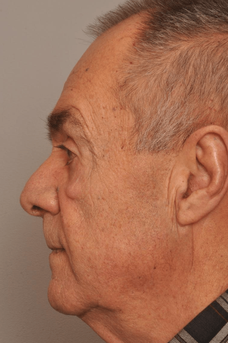 Mole/Lesion Removal Delaware | Premier Cosmetic Surgery DE