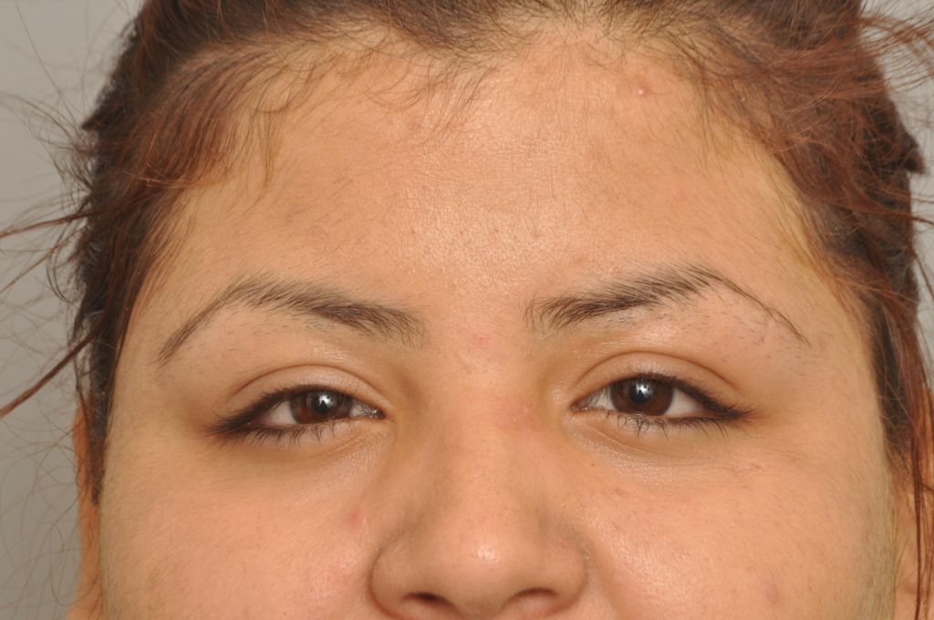 Mole/Lesion Removal Delaware | Premier Cosmetic Surgery DE