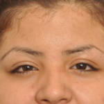 Mole/Lesion Removal Delaware | Premier Cosmetic Surgery DE