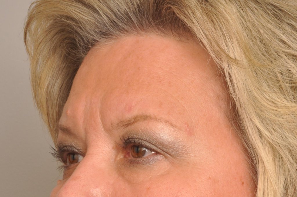 Mole/Lesion Removal Delaware | Premier Cosmetic Surgery DE