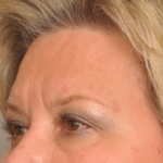 Mole/Lesion Removal Delaware | Premier Cosmetic Surgery DE