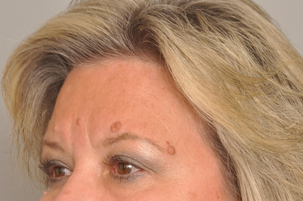 Mole/Lesion Removal Delaware | Premier Cosmetic Surgery DE