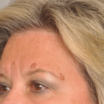 Mole/Lesion Removal Delaware | Premier Cosmetic Surgery DE