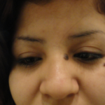 Mole/Lesion Removal Delaware | Premier Cosmetic Surgery DE