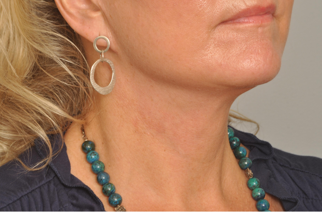 Lower Facelift/Necklift Delaware | Premier Cosmetic Surgery DE