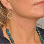 Lower Facelift/Necklift Delaware | Premier Cosmetic Surgery DE