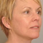 Lower Facelift/Necklift Delaware | Premier Cosmetic Surgery DE