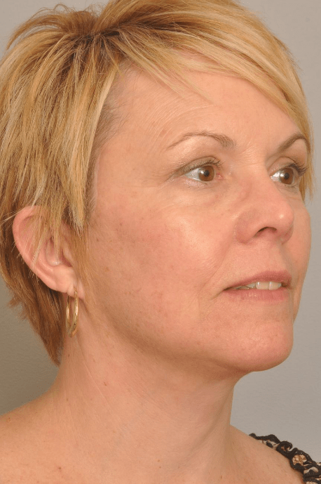 Lower Facelift/Necklift Delaware | Premier Cosmetic Surgery DE