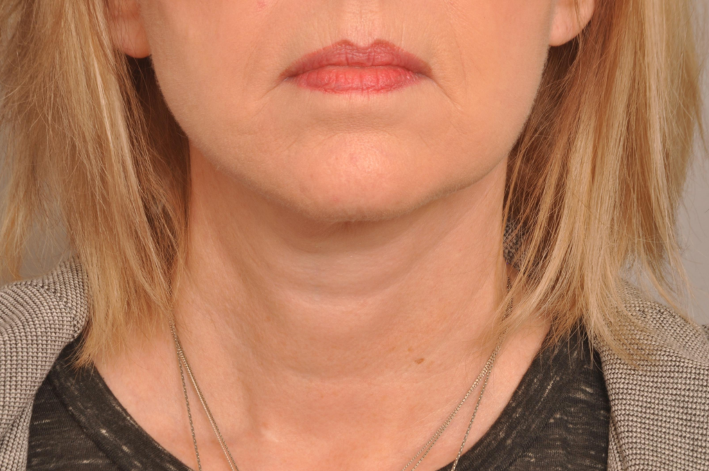 Lower Facelift/Necklift Delaware | Premier Cosmetic Surgery DE