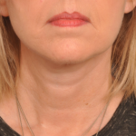 Lower Facelift/Necklift Delaware | Premier Cosmetic Surgery DE