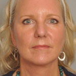 Lower Facelift/Necklift Delaware | Premier Cosmetic Surgery DE