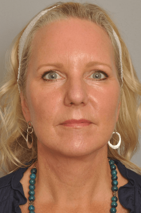 Lower Facelift/Necklift Delaware | Premier Cosmetic Surgery DE