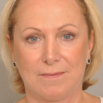 Lower Facelift/Necklift Delaware | Premier Cosmetic Surgery DE