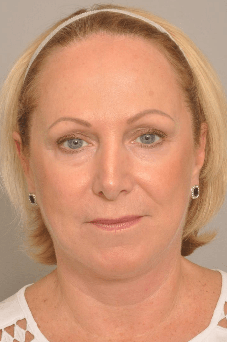 Lower Facelift/Necklift Delaware | Premier Cosmetic Surgery DE