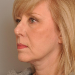 Lower Facelift/Necklift Delaware | Premier Cosmetic Surgery DE