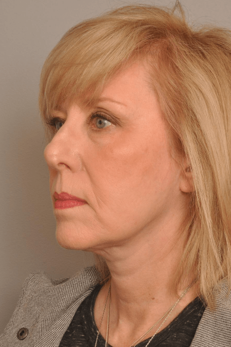 Lower Facelift/Necklift Delaware | Premier Cosmetic Surgery DE