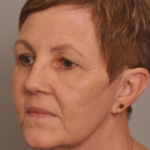 Lower Facelift/Necklift Delaware | Premier Cosmetic Surgery DE