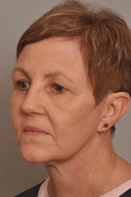 Lower Facelift/Necklift Delaware | Premier Cosmetic Surgery DE