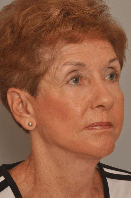 Lower Facelift/Necklift Delaware | Premier Cosmetic Surgery DE