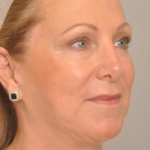 Lower Facelift/Necklift Delaware | Premier Cosmetic Surgery DE