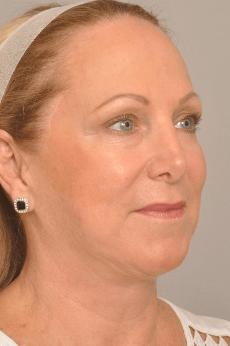 Lower Facelift/Necklift Delaware | Premier Cosmetic Surgery DE