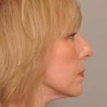 Lower Facelift/Necklift Delaware | Premier Cosmetic Surgery DE