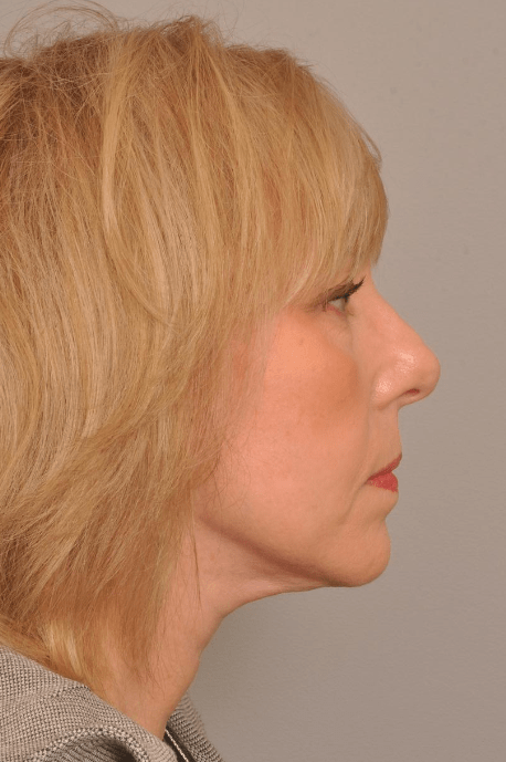 Lower Facelift/Necklift Delaware | Premier Cosmetic Surgery DE