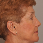 Lower Facelift/Necklift Delaware | Premier Cosmetic Surgery DE