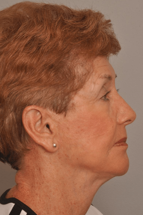 Lower Facelift/Necklift Delaware | Premier Cosmetic Surgery DE