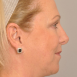 Lower Facelift/Necklift Delaware | Premier Cosmetic Surgery DE